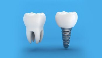 Do Dental Implants Get Cavities?