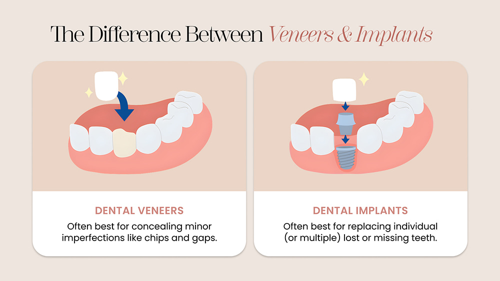 Dental Implants vs Veneers: Which Treatment Is Right for You?