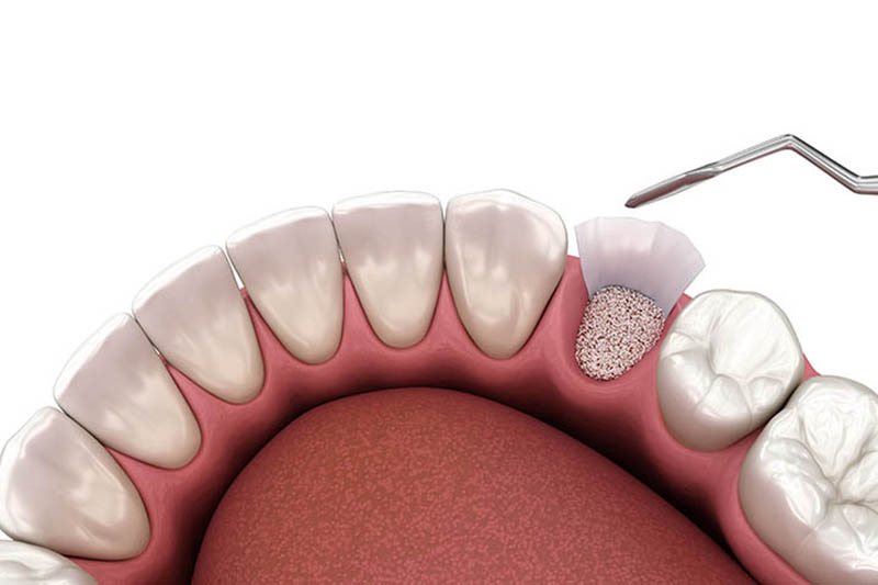 Top Benefits of Cosmetic Dentistry Grafts and Dental Implants