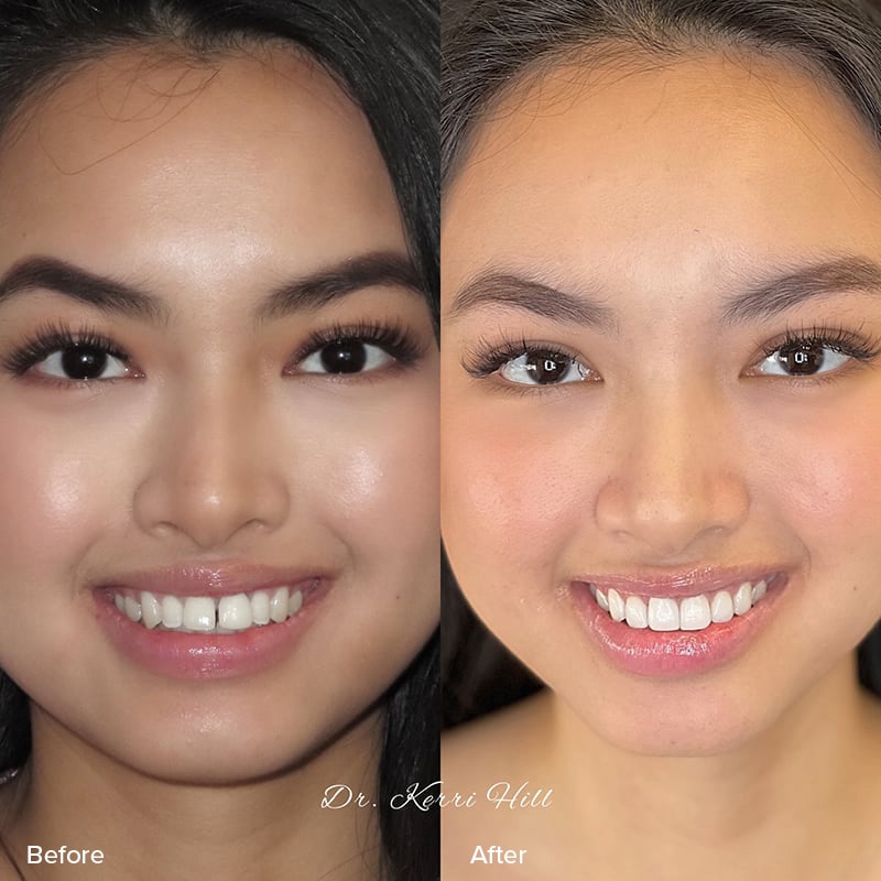 Veneers Before & After Image