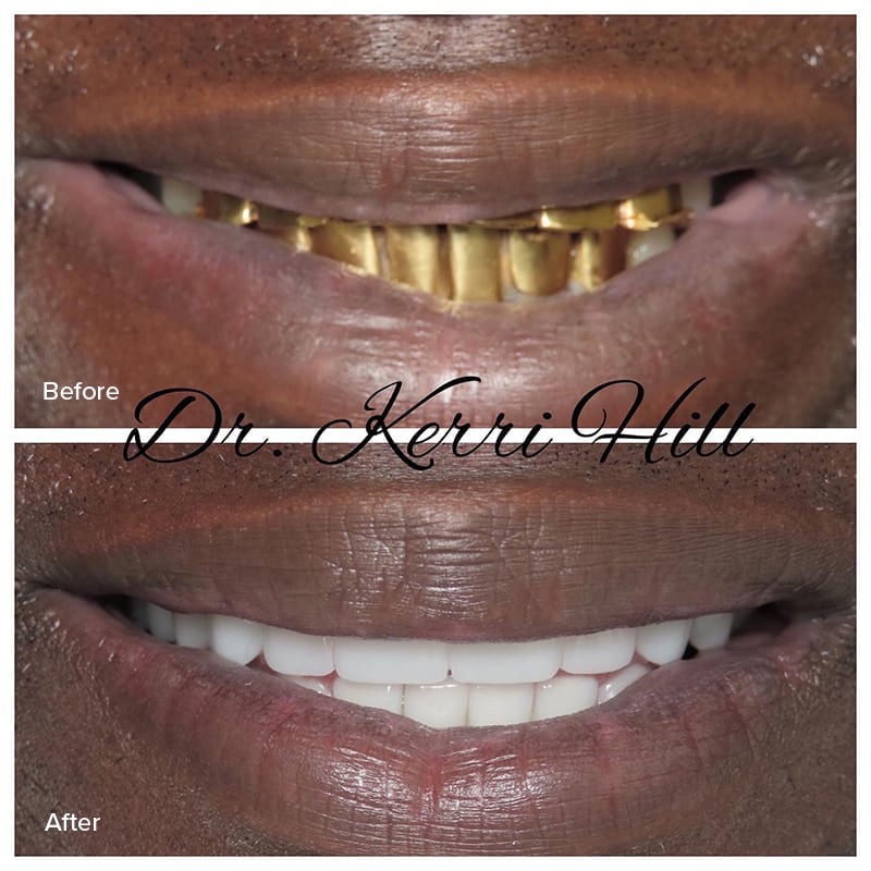 Dental Implants Before & After Image